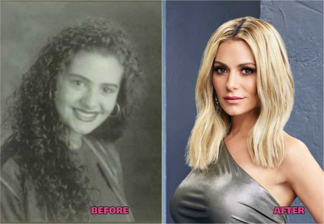 RHOBH Dorit Kemsley Plastic Surgery Before and After Photos