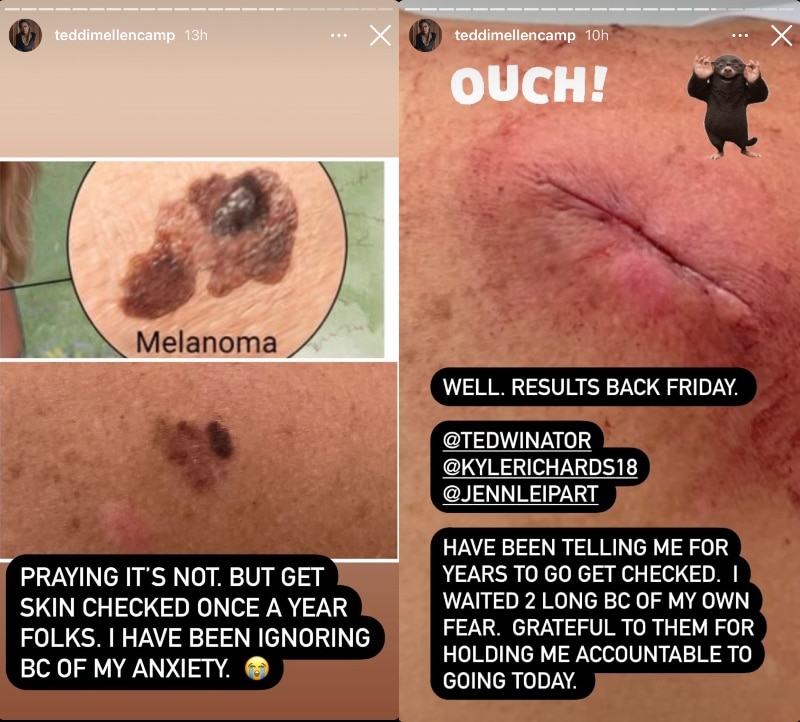 RHOBH Teddi Mellencamp Skin Cancer Scare