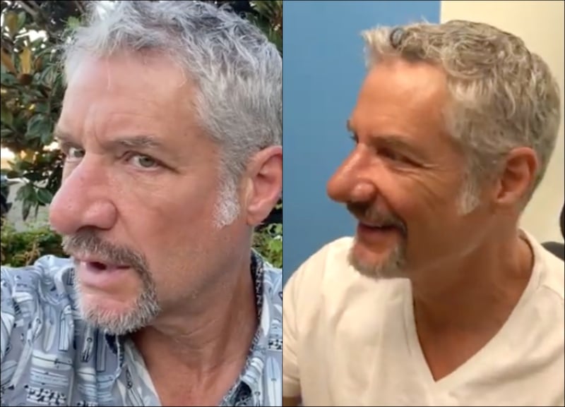 RHOC Rick Leventhal Nose Before and After Side View