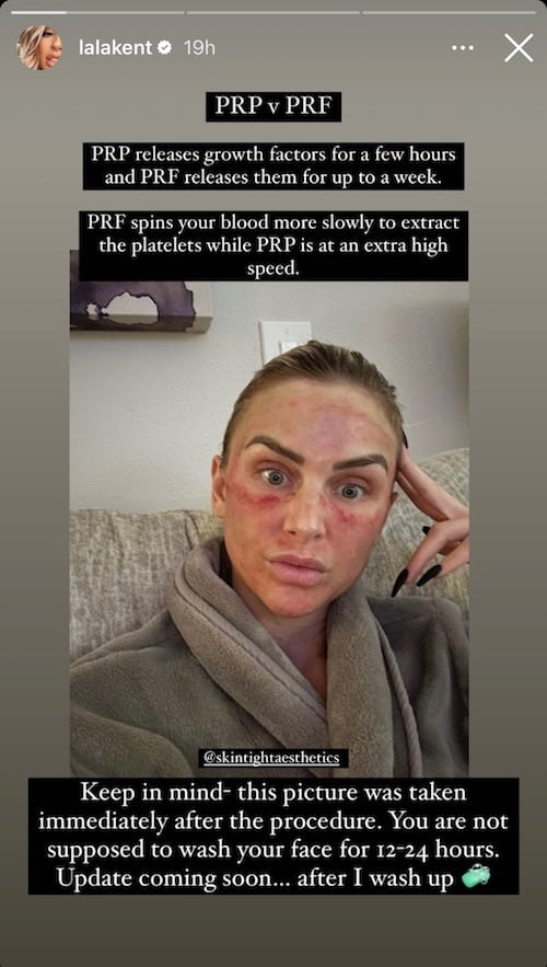 Vanderpump Rules Lala Kent on Difference Between PRP and PRF