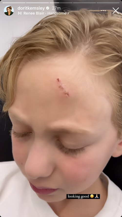 rhobh dorit kemsley shows son's injury after baseball bat accident