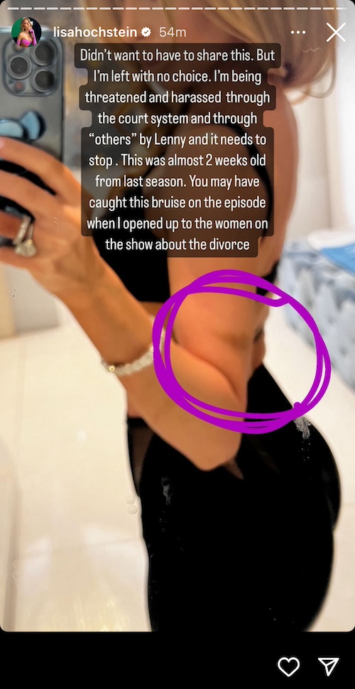 rhom lisa hocshtein shares abuse photo allegedly by lenny