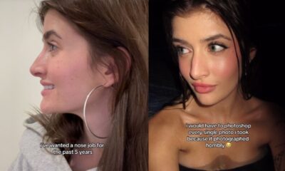 PHOTOS: Sami Sheen Gets Nose Job Months After Boob Job