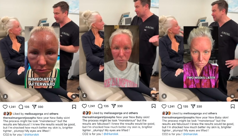 RHONJ Margaret Josephs Shares Pics of Results of CO2 Laser Treatment