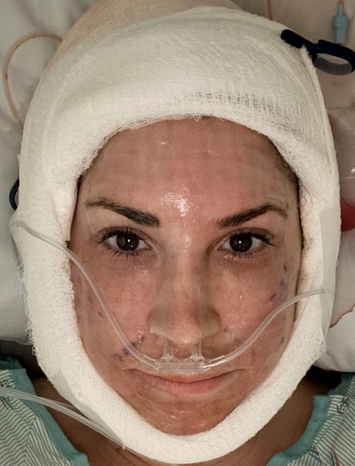 RHONJ Jacqueline Laurita After Facelift and Necklift Surgery