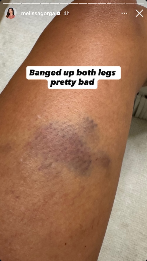 RHONJ Melissa Gorga Shows Photo of Injuries After Car Accident