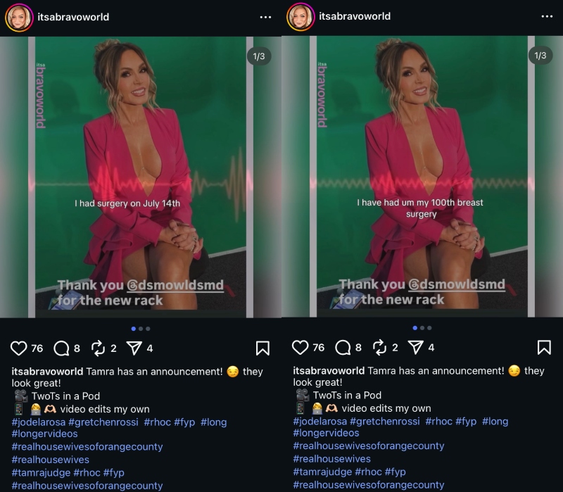 RHOC Tamra Judge Confirms Breast Augmentation Surgery