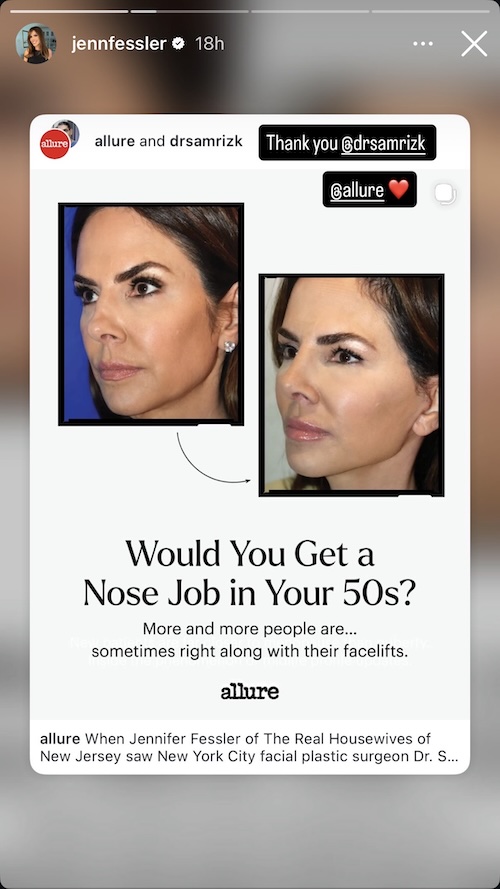 RHONJ Jennifer Fessler Shows Off Before & After Nose Job Pics