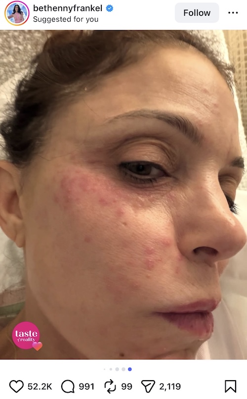 RHONY Bethenny Frankel Shows Off Bacterial Infection After St Barths Trip