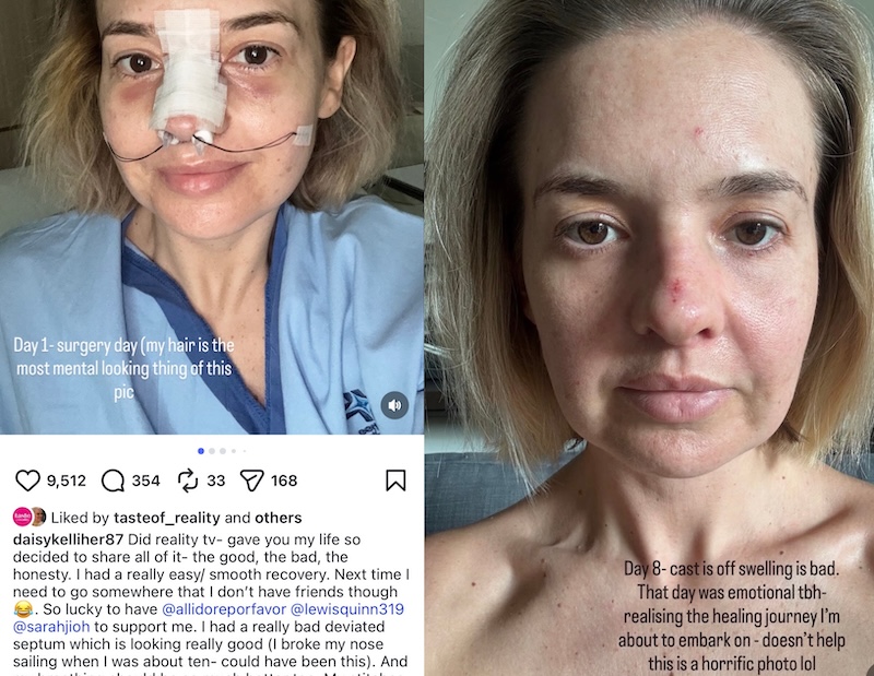 Below Deck Daisy Kelliher Shows Before & After Pics of Nose Job