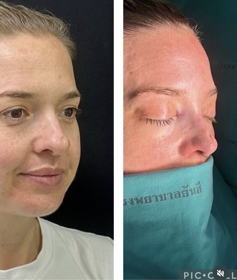 Side View of Daisy Kelliher's Nose Job