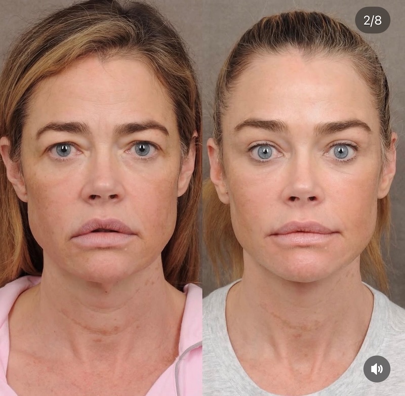 RHOBH Denise Richards Before and After Face Lift Front