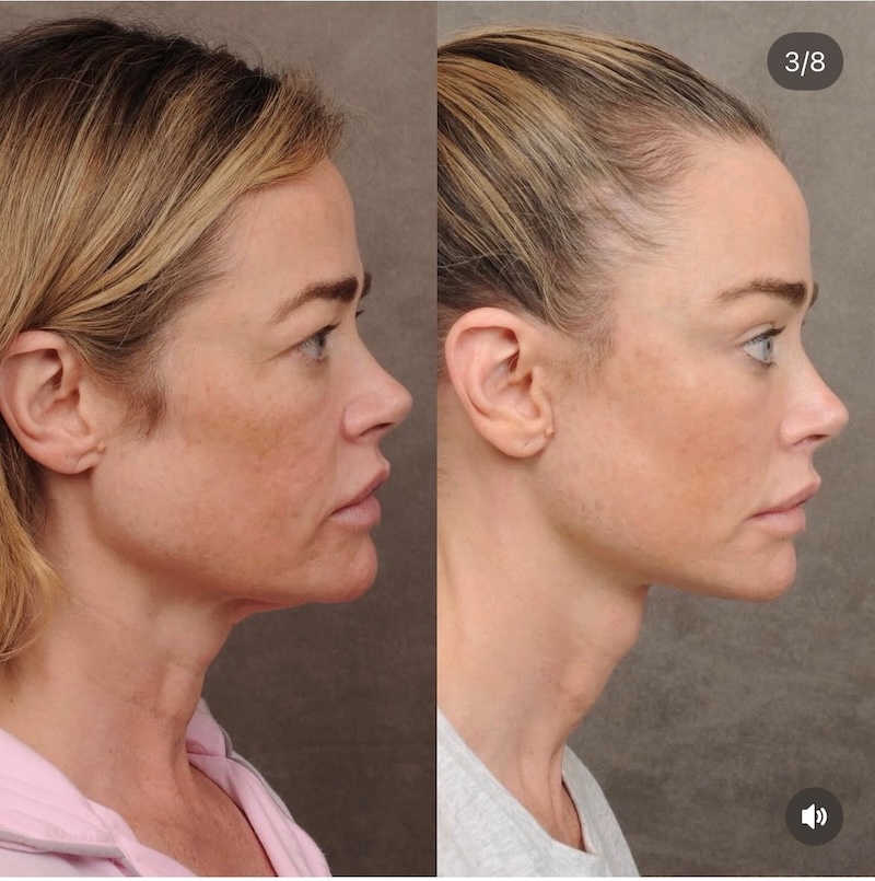 RHOBH Denise Richards Before and After Face Lift Side