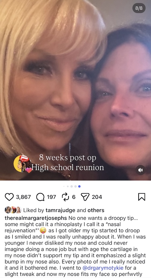 RHONJ Margaret Josephs Attends High School Reunion After Nose Job