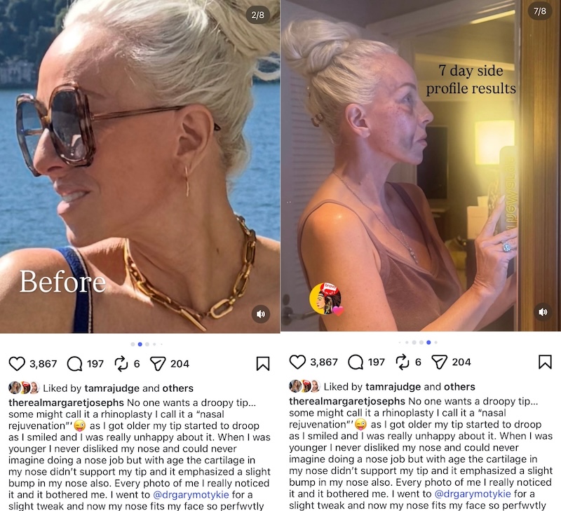 RHONJ Margaret Josephs Before and After Nose Job