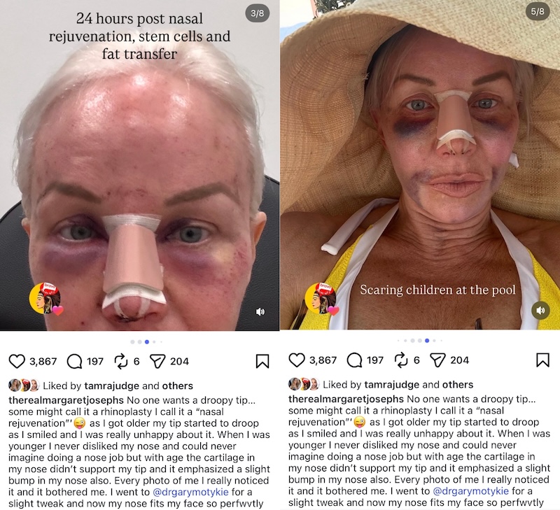 RHONJ Margaret Josephs Shares Post-Op Photos of Nose JOb