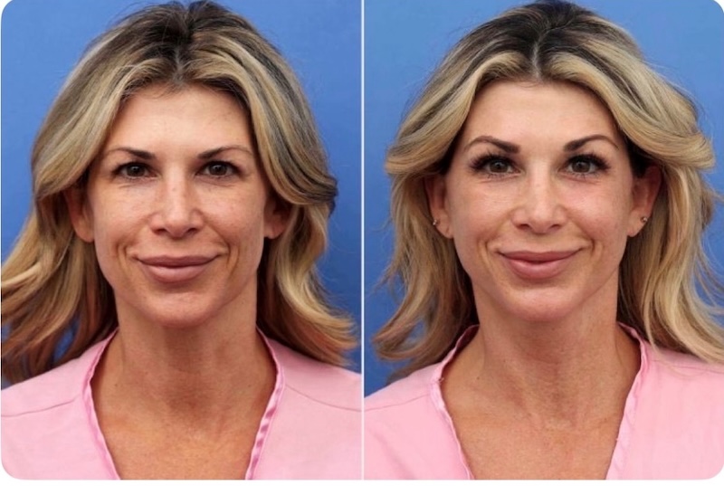 RHOC Alexis Bellino Before And After Facelift Pics