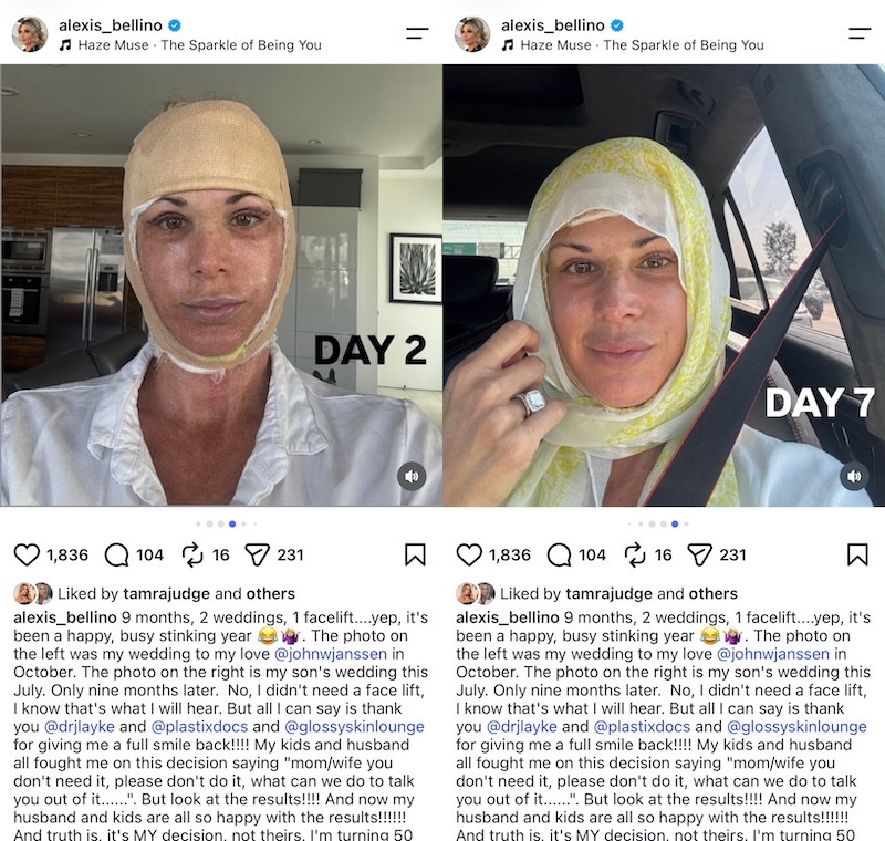 RHOC Alexis Bellino Post-Facelift Photos