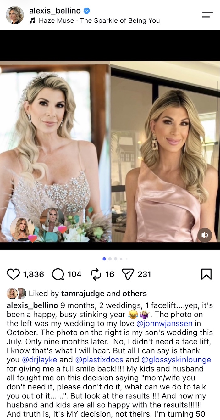 RHOC Alexis Bellino Before and After Facelift Photos